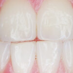 Come curare il digrignamento dei denti?