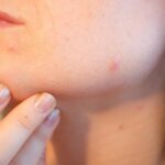 Cosa devi sapere sull’acne