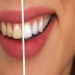 Come ottenere denti perfettamente bianchi: 11 consigli efficaci